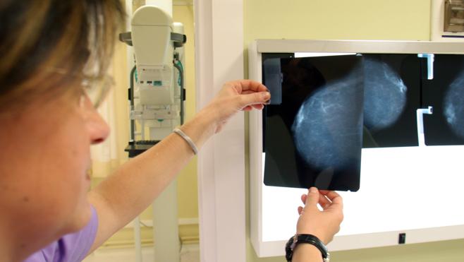 Los ginecólogos pedirán adelantar quince años las pruebas del cáncer de mama